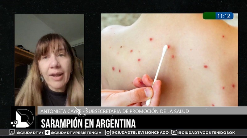 Recomiendan revisar esquemas de vacunación ante brote de sarampión: “Hay que estar en alerta permanente”